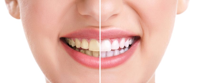 Blaqueamiento dental - Clínica Morena Dentistas