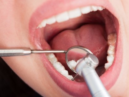 Endodoncia y tratamiento de conducto